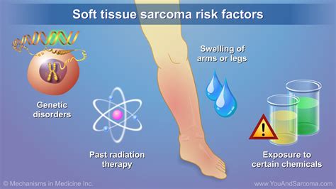 tests for soft tissue sarcoma|soft tissue sarcoma leg prognosis.